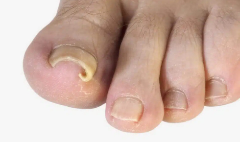 Huntsville ingrown toenail doctor